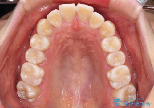 カリエール・ディスタライザーを併用したインビザライン矯正治療の治療前