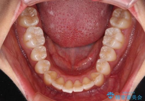 カリエール・ディスタライザーを併用したインビザライン矯正治療の治療前