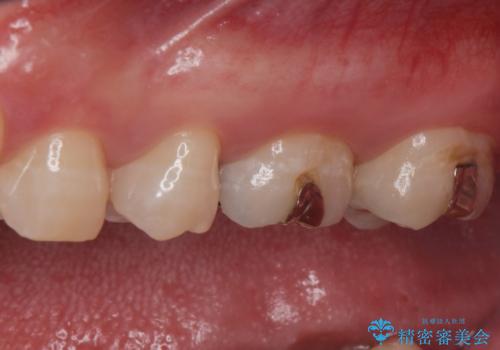 フルジルコニアクラウンの治療前