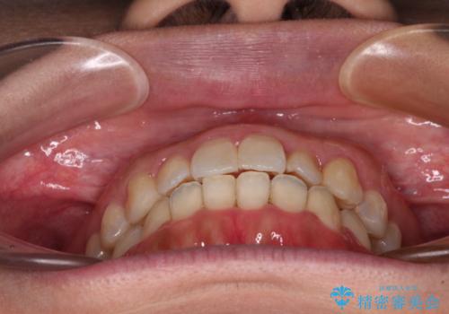 【モニター】上下前歯の叢生を解消　インビザライン矯正治療の治療中