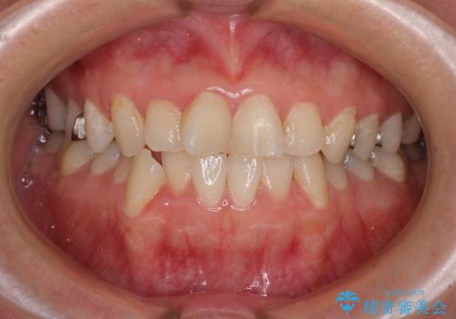 気になる歯列不正とむし歯を治療　インビザライン治療と虫歯治療の症例 治療前
