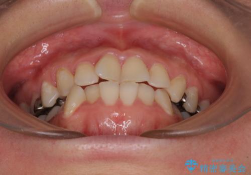 気になる歯列不正とむし歯を治療　インビザライン治療と虫歯治療の治療前