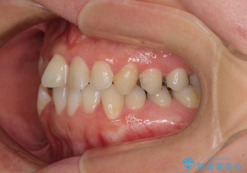 気になる歯列不正とむし歯を治療 インビザライン治療と虫歯治療の治療前