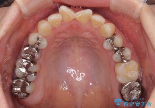気になる歯列不正とむし歯を治療 インビザライン治療と虫歯治療の治療前