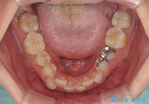 気になる歯列不正とむし歯を治療　インビザライン治療と虫歯治療の治療前