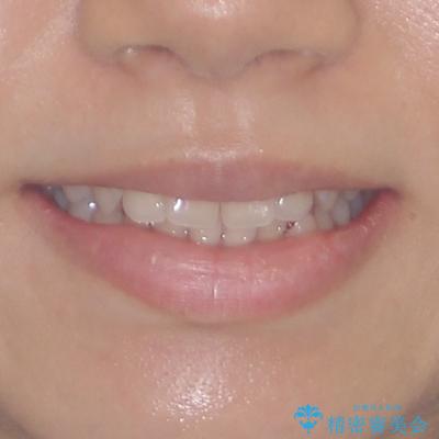 前に出てきた歯列を改善　ワイヤー装置での再矯正治療の治療前（顔貌）