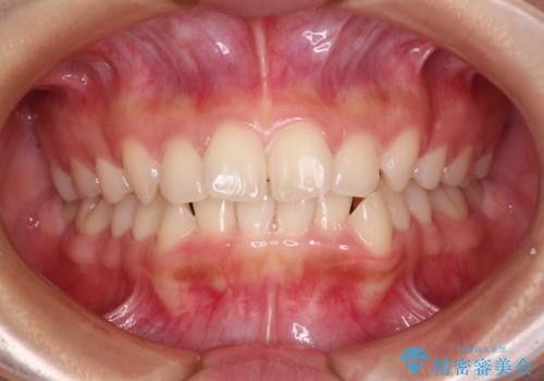 前に出てきた歯列を改善 ワイヤー装置での再矯正治療の症例 治療前