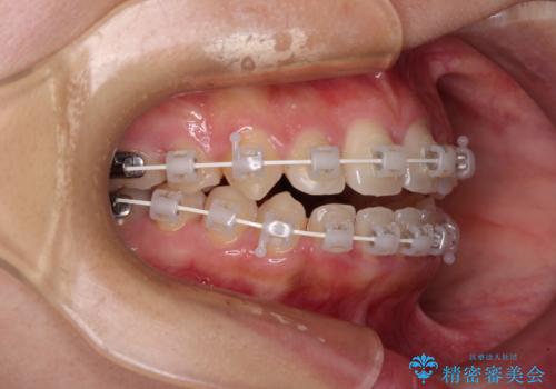 前に出てきた歯列を改善　ワイヤー装置での再矯正治療の治療中