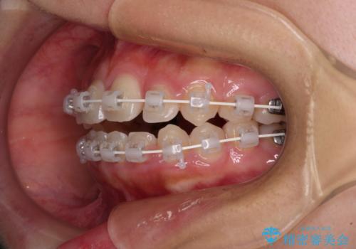 前に出てきた歯列を改善　ワイヤー装置での再矯正治療の治療中
