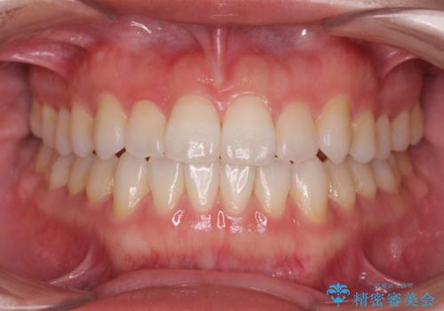 受け口傾向のマウスピース矯正 (ワイヤー治療を併用して)の症例 治療後