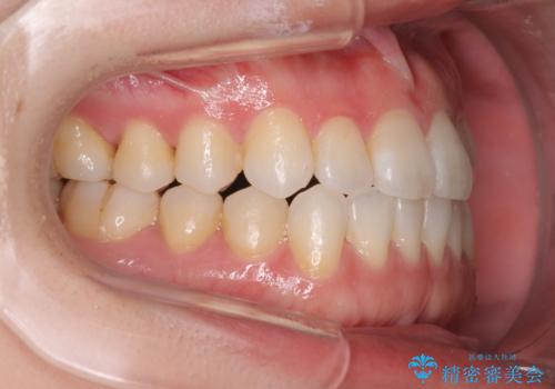 受け口傾向のマウスピース矯正 (ワイヤー治療を併用して)の治療後