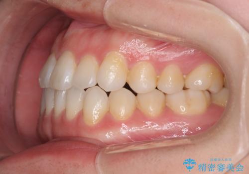 受け口傾向のマウスピース矯正 (ワイヤー治療を併用して)の治療後