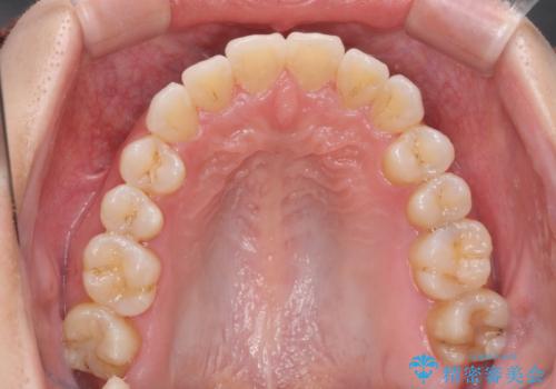 受け口傾向のマウスピース矯正 (ワイヤー治療を併用して)の治療後