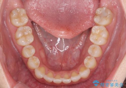 受け口傾向のマウスピース矯正 (ワイヤー治療を併用して)の治療後