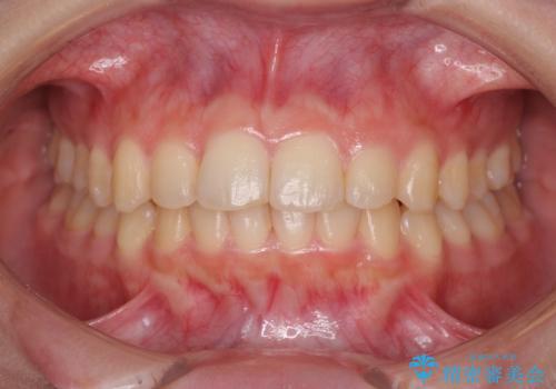半年で行えるマウスピース矯正の症例 治療後