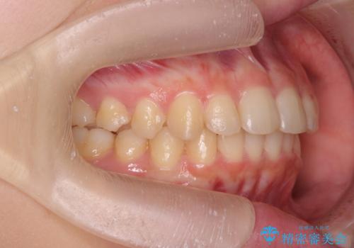 半年で行えるマウスピース矯正の治療後