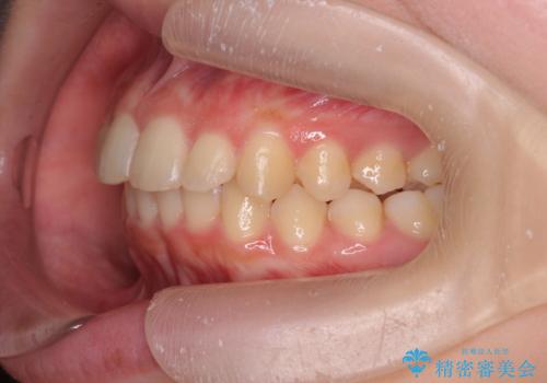 半年で行えるマウスピース矯正の治療後