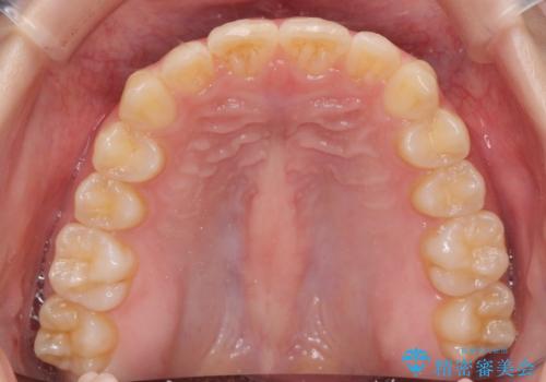 半年で行えるマウスピース矯正の治療後