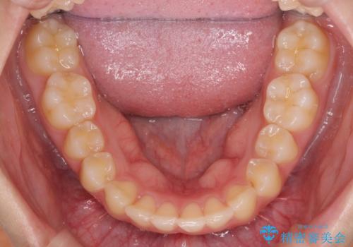 半年で行えるマウスピース矯正の治療後