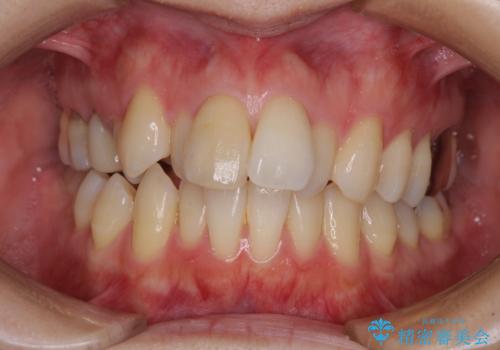 V字型に飛び出した前歯 ワイヤー装置での抜歯矯正の症例 治療前