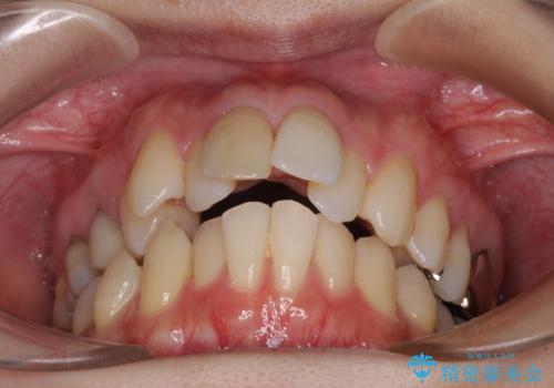 V字型に飛び出した前歯 ワイヤー装置での抜歯矯正の治療前