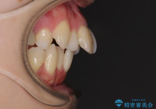 V字型に飛び出した前歯　ワイヤー装置での抜歯矯正の治療前