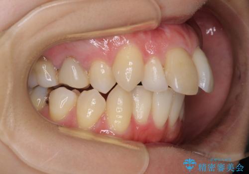 V字型に飛び出した前歯 ワイヤー装置での抜歯矯正の治療前