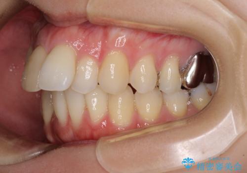 V字型に飛び出した前歯 ワイヤー装置での抜歯矯正の治療前