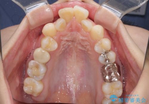 V字型に飛び出した前歯 ワイヤー装置での抜歯矯正の治療前