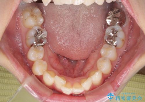 V字型に飛び出した前歯 ワイヤー装置での抜歯矯正の治療前