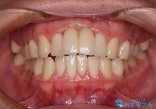 下顎前歯の部分矯正　目立たないワイヤー装置の症例 治療前
