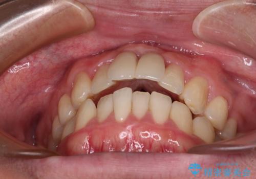 下顎前歯の部分矯正 目立たないワイヤー装置の治療前