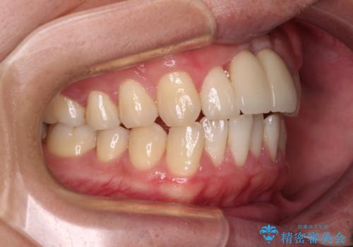 下顎前歯の部分矯正 目立たないワイヤー装置の治療前
