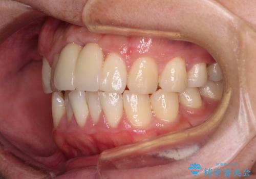 下顎前歯の部分矯正　目立たないワイヤー装置の治療前