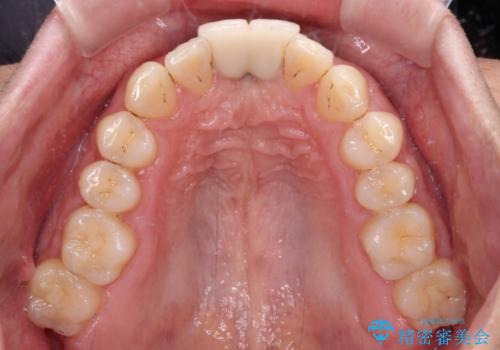 下顎前歯の部分矯正 目立たないワイヤー装置の治療前