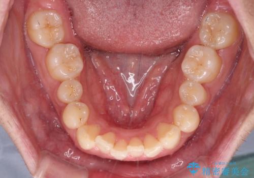 下顎前歯の部分矯正 目立たないワイヤー装置の治療前