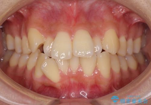 目立たないハーフリンガル矯正　抜歯矯正で口元の突出感を改善の症例 治療前
