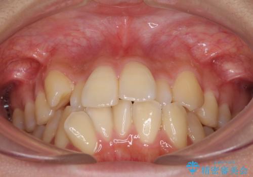 目立たないハーフリンガル矯正 抜歯矯正で口元の突出感を改善の治療前