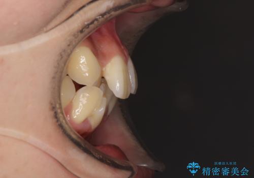 目立たないハーフリンガル矯正 抜歯矯正で口元の突出感を改善の治療前