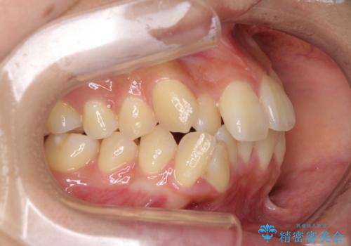 目立たないハーフリンガル矯正 抜歯矯正で口元の突出感を改善の治療前