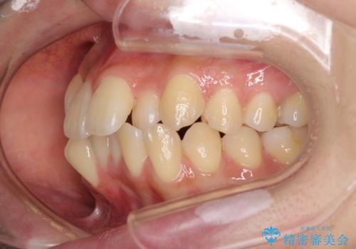 目立たないハーフリンガル矯正　抜歯矯正で口元の突出感を改善の治療前
