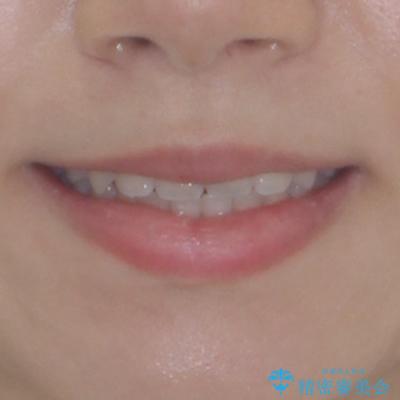 前に出てきた歯列を改善　ワイヤー装置での再矯正治療の治療後（顔貌）