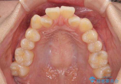 目立たないハーフリンガル矯正 抜歯矯正で口元の突出感を改善の治療前