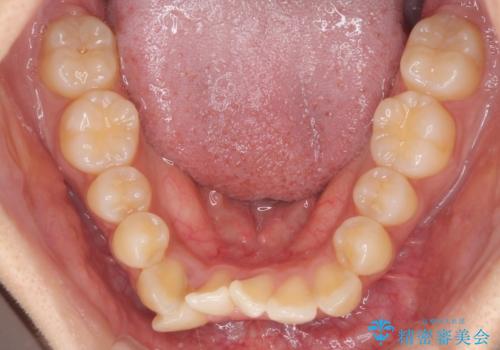 目立たないハーフリンガル矯正　抜歯矯正で口元の突出感を改善の治療前