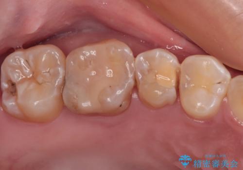 奥歯に物が挟まる　セラミックインレーによる虫歯治療の症例 治療前