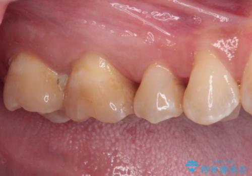 奥歯に物が挟まる　セラミックインレーによる虫歯治療の治療前