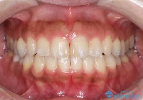 前歯のガタつきをマウスピース矯正で改善!　驚きの効果を体験しようの症例 治療後