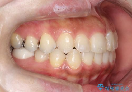 前歯のガタつきをマウスピース矯正で改善! 驚きの効果を体験しようの治療後