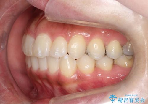 前歯のガタつきをマウスピース矯正で改善! 驚きの効果を体験しようの治療後