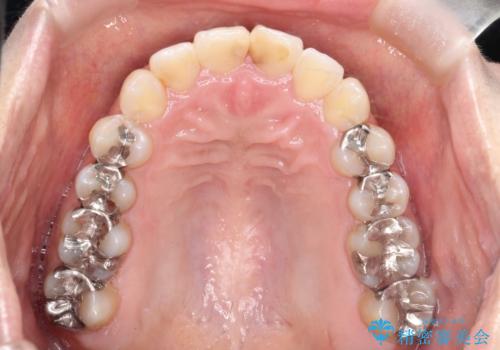 前歯のガタつきをマウスピース矯正で改善!　驚きの効果を体験しようの治療後